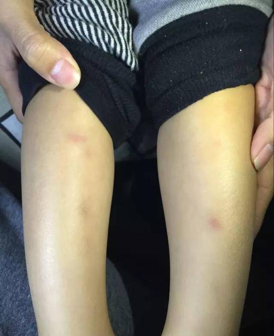 天津一幼兒園被曝“針扎兒童” 因孩子沒按時(shí)睡覺